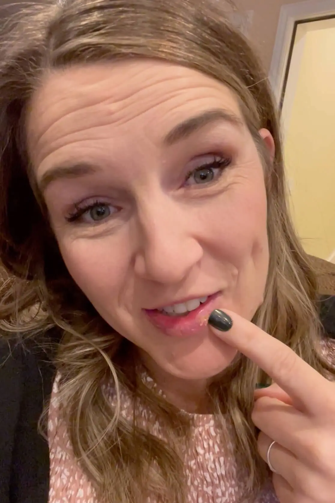 Close-up of woman pointing to a healing cold sore on her lip, emphasizing the effectiveness of natural remedies like L-Lysine.